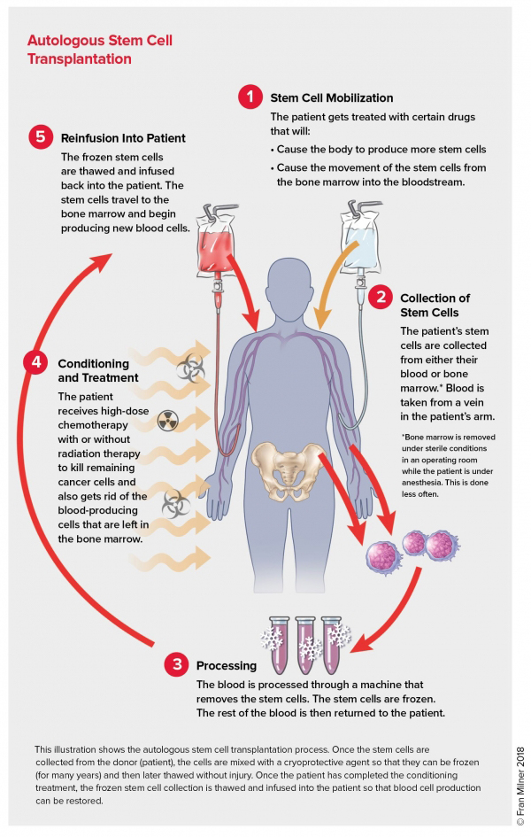 Autologous Stem Cell Transplant illustration
